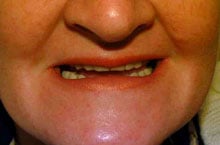 before porcleain dentures