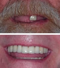 dental implants all missing teeth