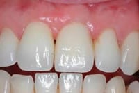 dental implant after placement