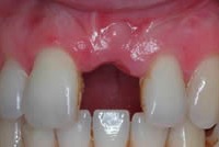 dental implants single tooth