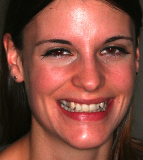 picture of face crooked front teeth