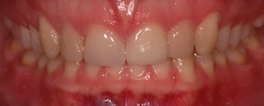 closed a gap between front teeth after invisalign treatment