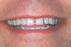 teeth gaps in front teeth