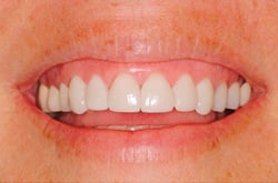after lumineers to correct stained teeth