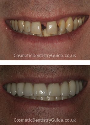 dental veneers close up photos