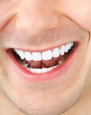 BBC Investigation Reveals Insight into Illegal Teeth Whitening