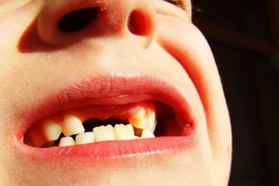 Big Smiles in Glasgow as Fewer Children Have Their Teeth Pulled