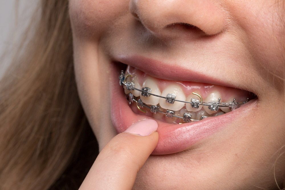 Obesity Can Affect Orthodontic Treatment, Dental Researchers Claim