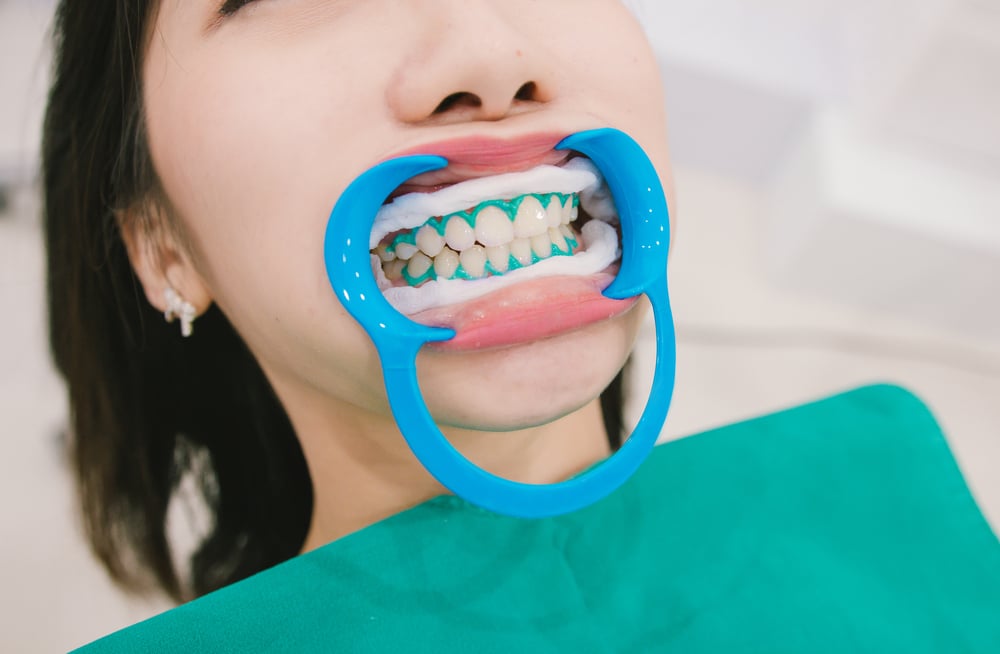 Illegal Teeth Whitening Treatments Rise, Claim GDC