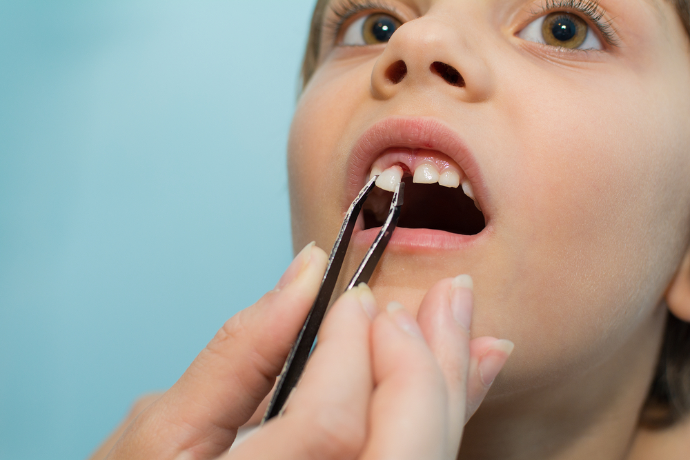 Australian dentists despair over childhood extraction rates