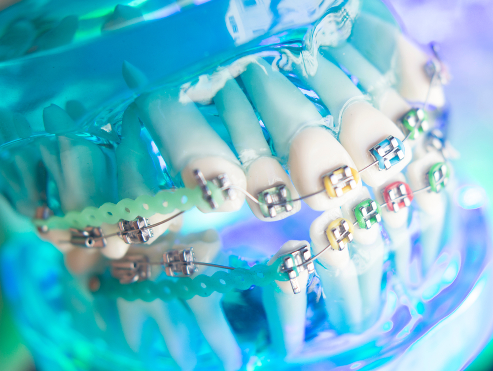 Dentists warn of the dangers of DIY brace videos on YouTube