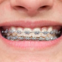 German insurance companies could limit braces cover after study reveals lack of evidence to support long-term dental health benefits