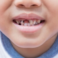 A third of Fife children still have tooth decay, despite major improvements