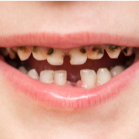 New study suggests fillings may not be the best option to treat childhood decay