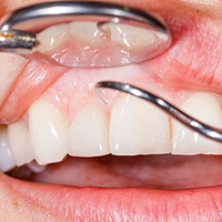 New study links gum disease to higher risks of some types of cancer