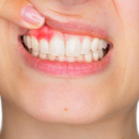 Study links gum disease to COVID-19 complications