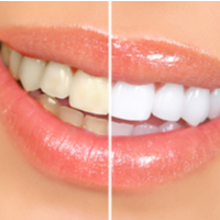 Dentist highlights dangers of DIY tooth whitening