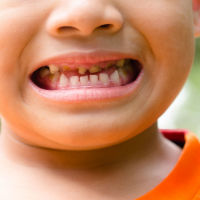British Dental Association calls for action to tackle rising rates of decay among children