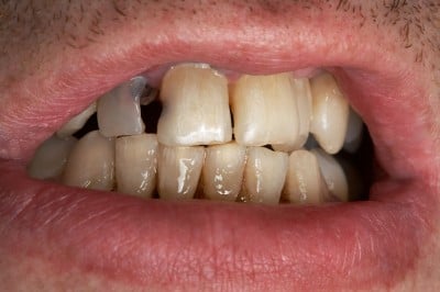 Study Links Mental Health Conditions to Increased Risk of Dental Problems 
