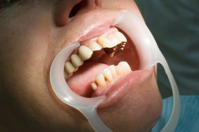 Researchers investigate cause of gum disease in males