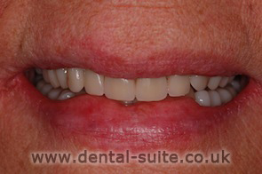 after implants and dentures