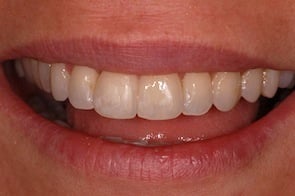 after 6 month smiles braces