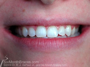 six month smiles after treatment