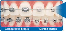 damon braces image