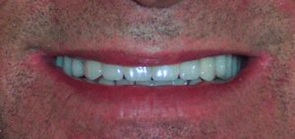 after porcleain dentures