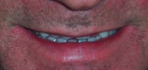 before porcleain dentures
