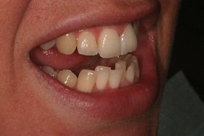 before inman aligner treatment on lower teeth