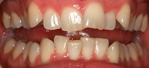 close up pitcture of crooked upper and lower teeth