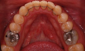 close up photo of straight teeth after invisible braces treatment