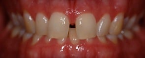close up pitcture of large gaps between front teeth