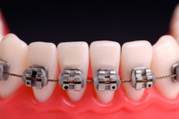 Could A New Balloon Device Replace Traditional Braces?