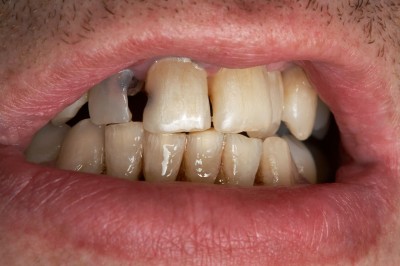 New Study Shows that 1 in 4 Dread Smiling Due to Bad Teeth