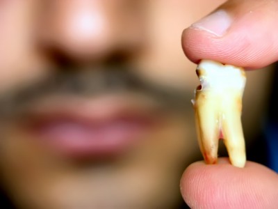 New Study Links Cannabis to Premature Tooth Loss