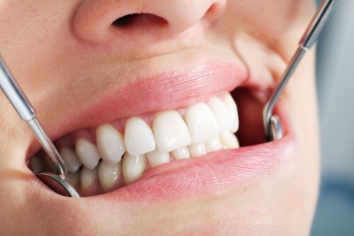 Scottish Teenager Shares Teeth Whitening Horror Story