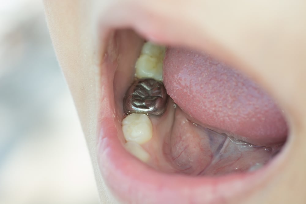Dentists share concerns over enamel loss in young patients