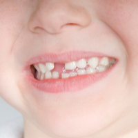 Gold Coast dentist warns parents over increased incidence of dental injuries over the festive period