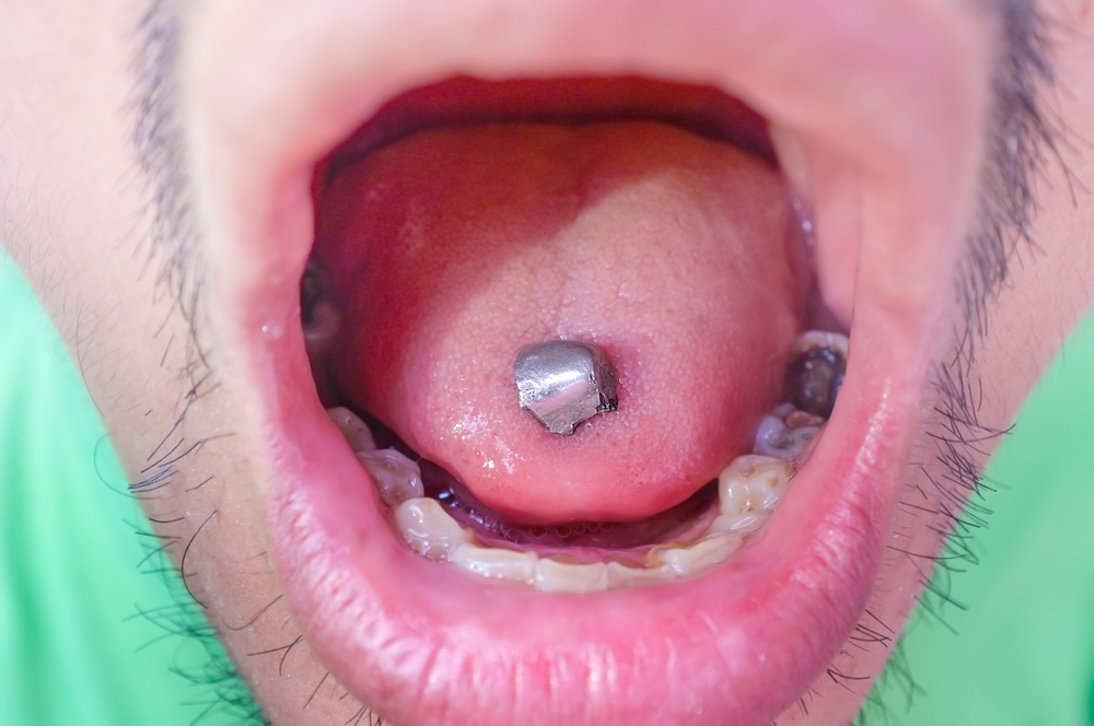 Amalgam fillings to be phased out in Ireland
