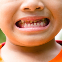 Standards of oral health are deteriorating among Peterborough’s children