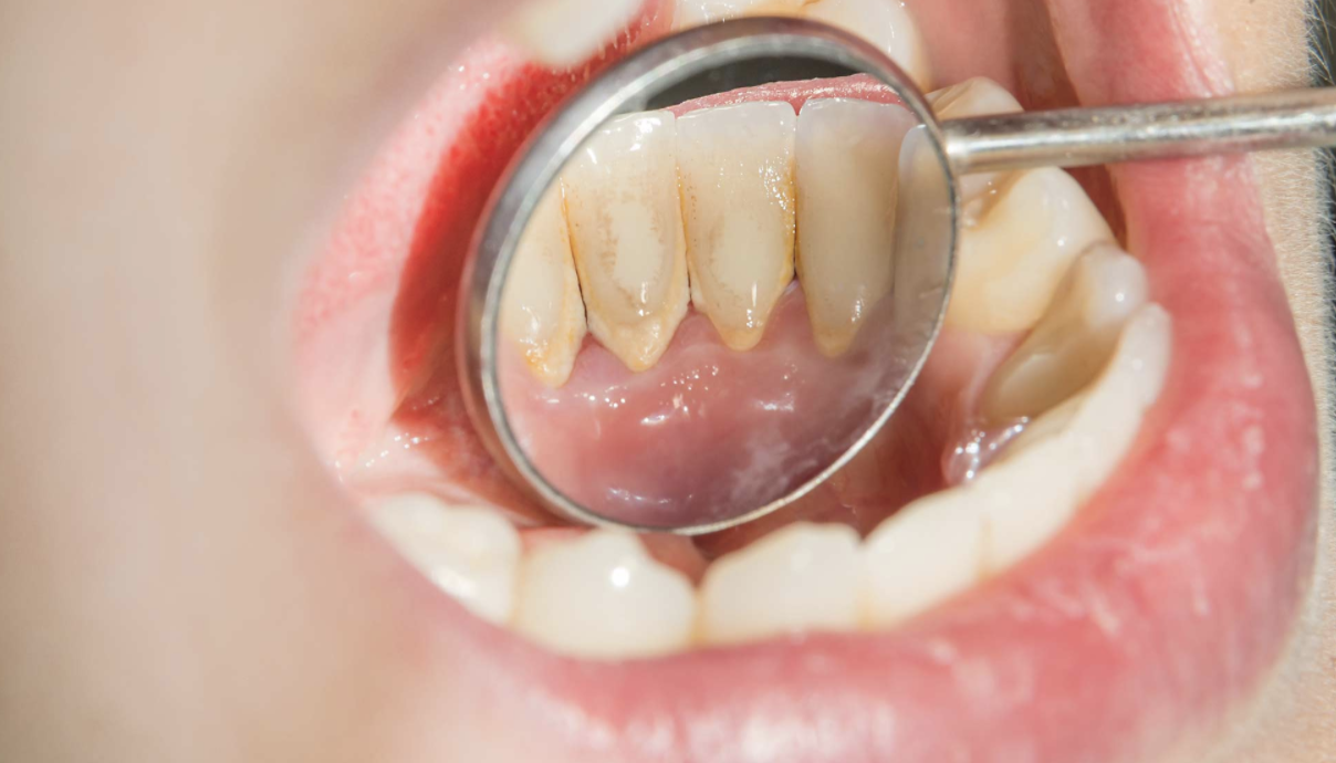 New research links gum disease to increased risk of Covid-19 complications