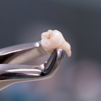 Swansea man extracts his own tooth after struggling to find a dentist