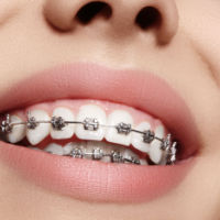 Wolverhampton dentist issues warning over unsupervised orthodontic treatment