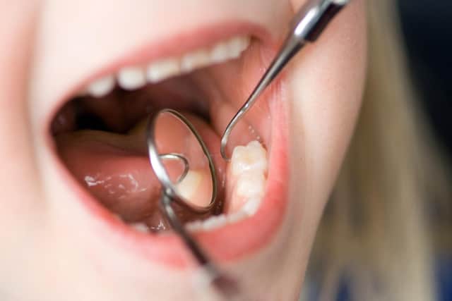 More than half of Peterborough’s 5-year-olds have dental problems