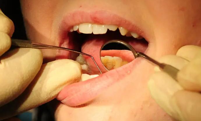 Over 50% of 5-year-olds in Bolton have dental decay