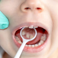 Thousands of children missing out on routine dental checks in Ireland