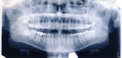 Royal dental X-rays go up for auction