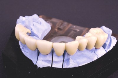 Dental Implants Overtake Dentures as the Treatment of Choice for Missing Teeth 